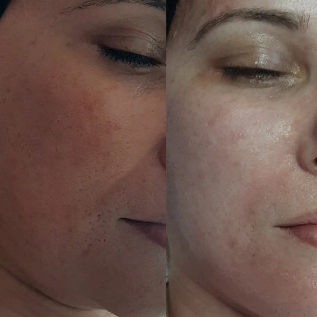 Elin Sary Mary Kutak #beograd Medicinski pedikir Derma Fix tretman lica sa kolagenskim nitima - paket od 3 tetmana