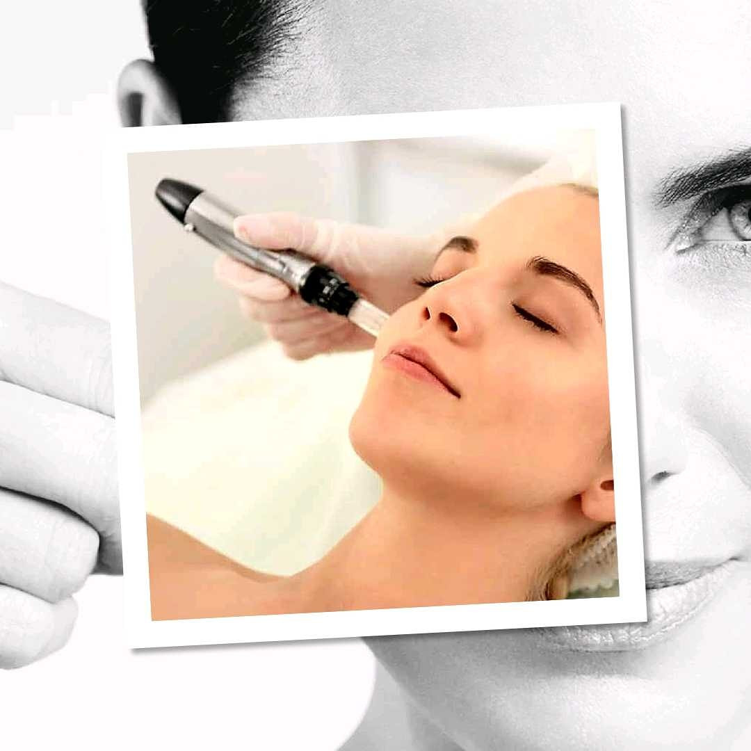 Freya 1 #beograd Mezoterapija lica Mezoterapija dermapenom protiv hiperpigmentacije