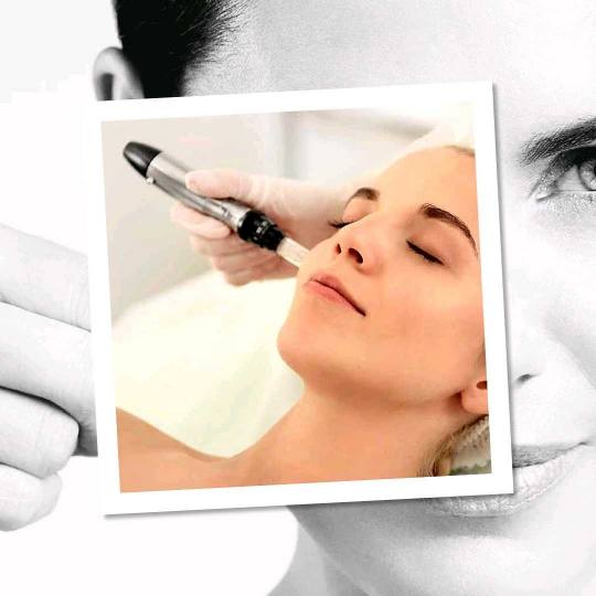 Freya 1 #beograd Mezoterapija lica Mezoterapija dermapenom protiv hiperpigmentacije