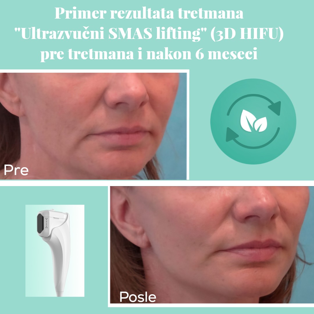 Vita Elos #novisad Lifting / zatezanje kože Ultrazvučni SMAS lifting (3D HIFU tehnologija) - celog lica