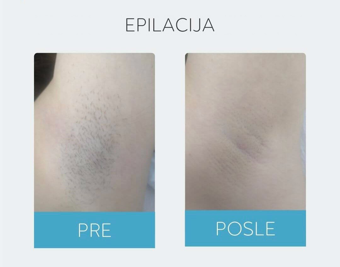 DepilConcept #beograd