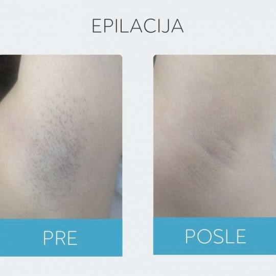 DepilConcept #beograd