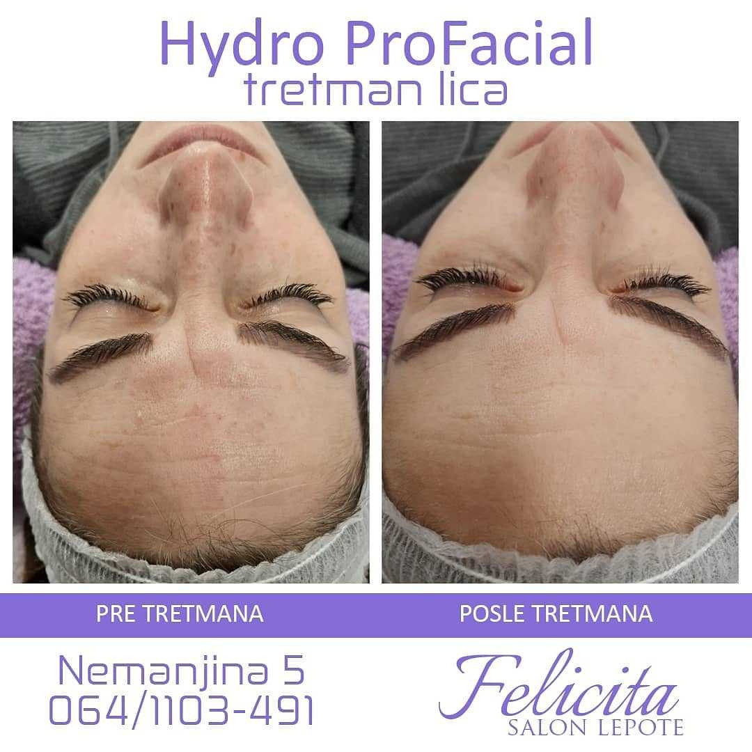 Felicita #beograd Tretman lica Hydro Pro Facial 7in1