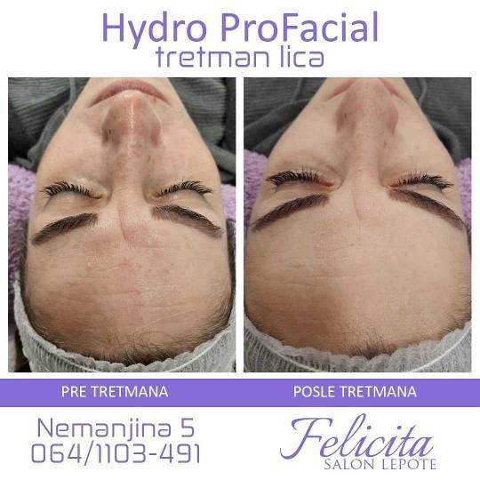 Felicita #beograd Tretman lica Hydro Pro Facial 7in1