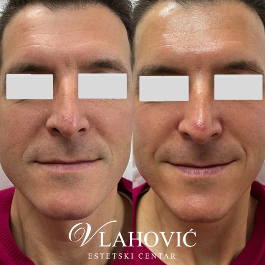 Estetski centar Vlahović #beograd Tretman lica HYDRAFACIAL - regeneracija i rejuvenacija kože Holi