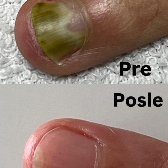 Belle Ana #beograd Tretmani tela Lasersko uklanjanje gljivica noktiju Lasersko uklanjanje gljivica n