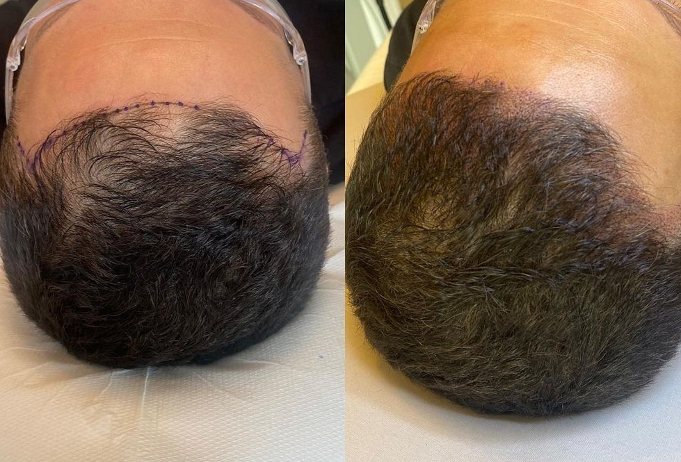 Esthetique Privé #beograd Obrve Scalp Micropigmentation po regiji