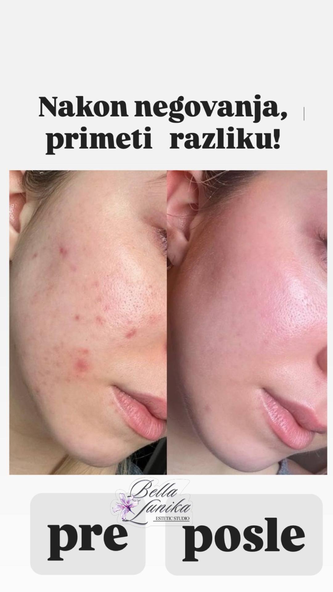 Mesopeel - AMP / DMP / RMP - Bella Lunika Estetic studio, Pančevo Tretman lica Lice Tretman lica, Pančevo, Centar