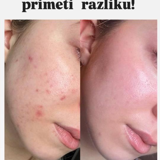 Bella Lunika Estetic studio #pancevo Tretman lica Mesopeel - AMP / DMP / RMP Higijenski tretman lica