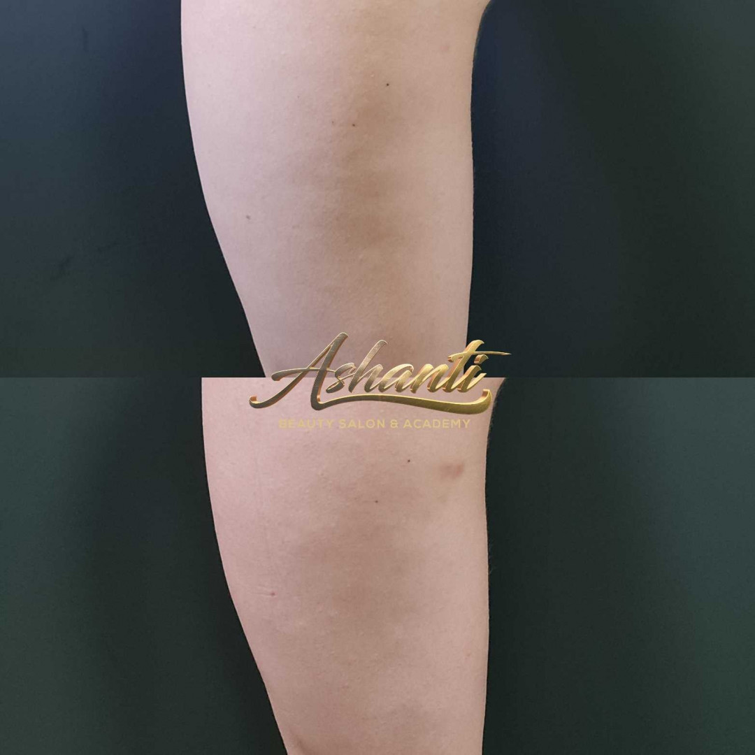 Ashanti Beauty Salon & Academy #beograd Masaža za mršavljenje Dermapen - regija lica
