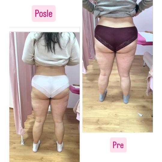 Mademoiselle Natalie studio #beograd Anticelulit LUX 10 maderoterapije+10 limfne drenaze+ brazilske 