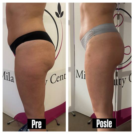 Mila Beauty Centar #beograd Anticelulit masaža Anticelulit ručna masaža Rezultati nakon serije od