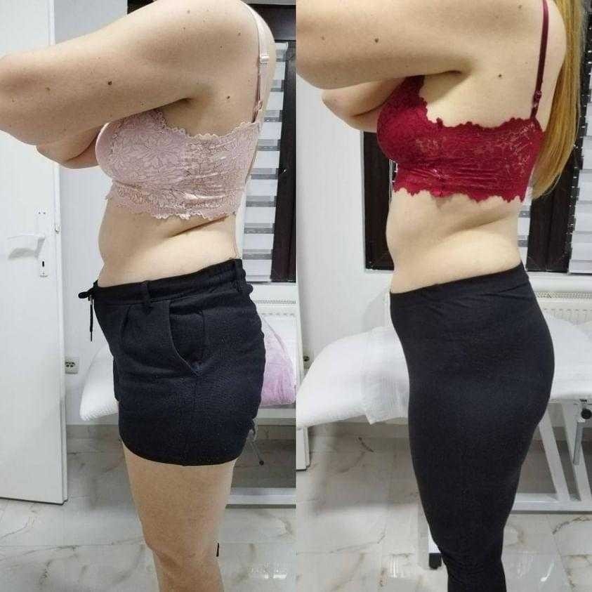 Beauty Team J&S 037 #krusevac Elektrostimulacija mišića Elektostimulacija mišića za dame - po regiji